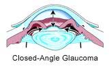 Closed Angle Glaucoma